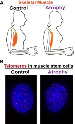 Illustration and microscope slide of muscular atrophy